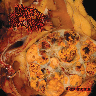 Blasted Pancreas- Carcinoma